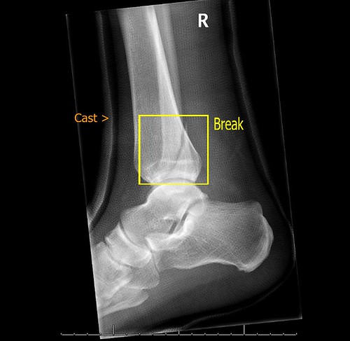 Joints health concept